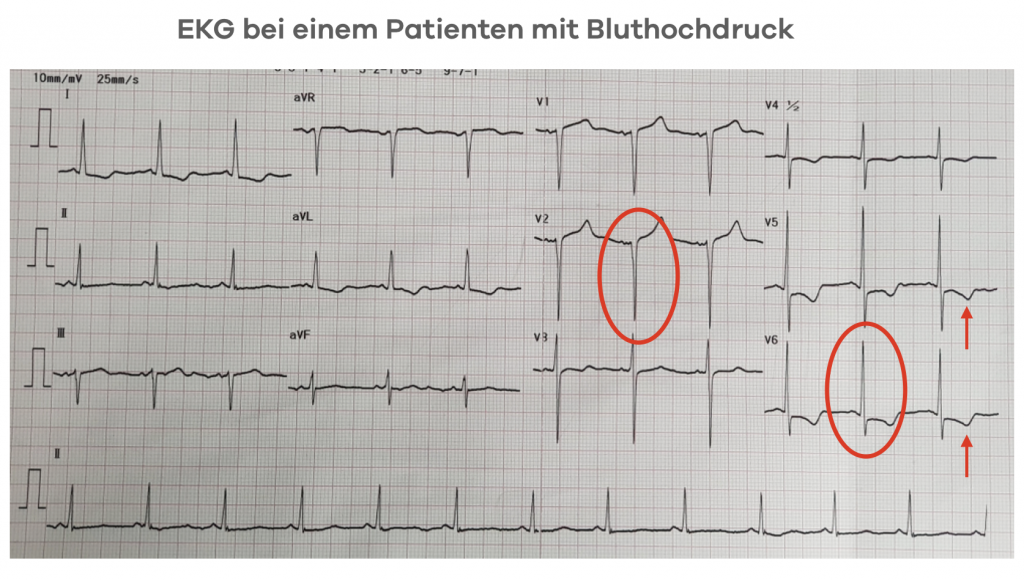EKG bei hohem Blutdruck (Hypertonie) Zeichen für eine Verdickung des Herzmuskels (Linksventrikuläre Hypertrophie)