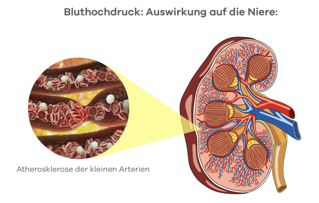 Hochdruck und Niere: Wenn ein Bluthochdruck länger besteht werden die  kleinen Arterien der Niere durch Atherosklerose geschädigt. Diese führt im laufe der Zeit zu einer Nierenschädigung (Niereninsuffizienz)