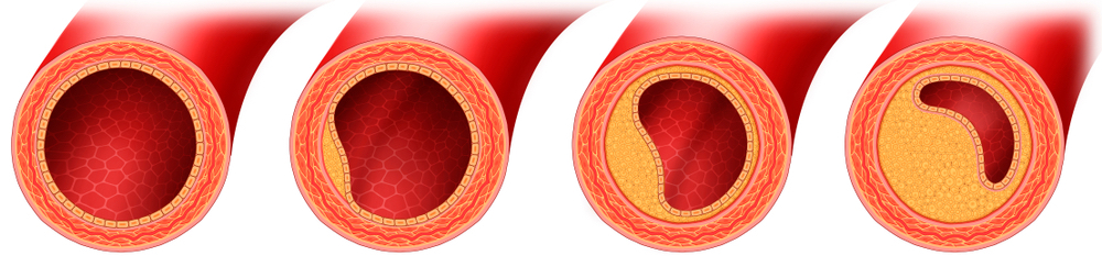 Stadien der Atherosklerose. Die  Blutfette spielen bei hohem Blutdruck eine wichtige Rolle