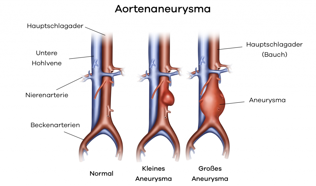 Aortenaneurysma Bauchschlagader