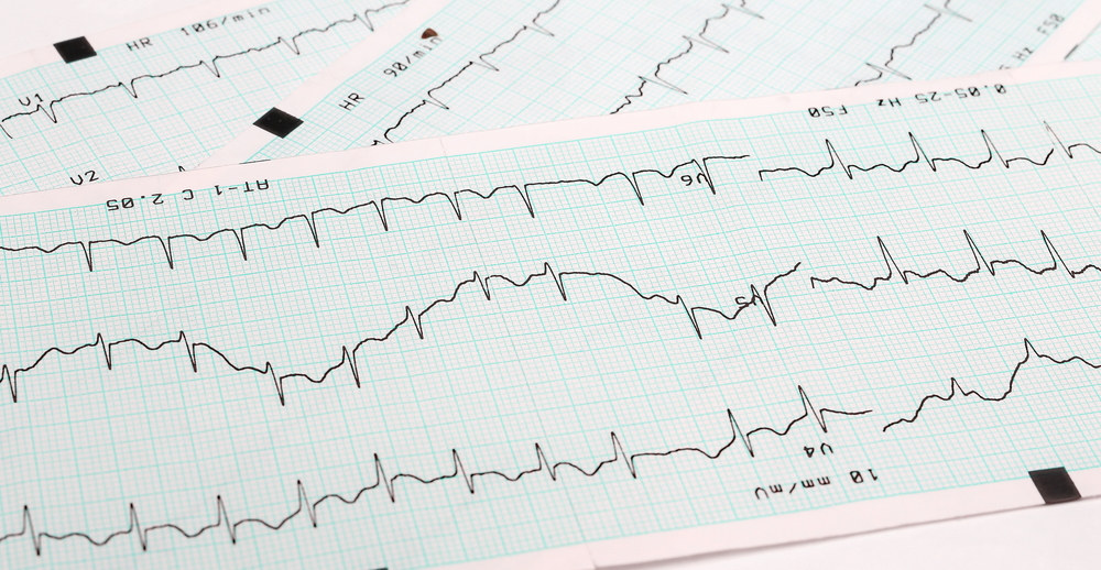EKG mit Vorhofflimmern, einer häufigen Rhythmusstörung bei hohen Blutdruck