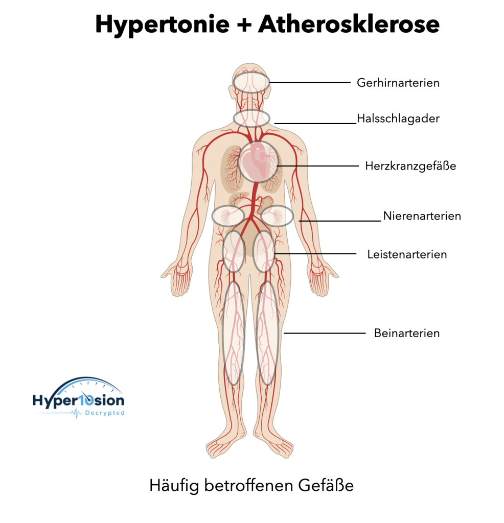Hypertonie Atherosklerose Welche Gefäße sind betroffen?